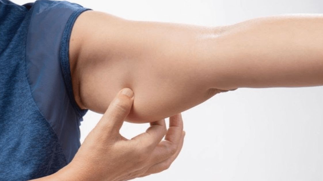 Arm fat